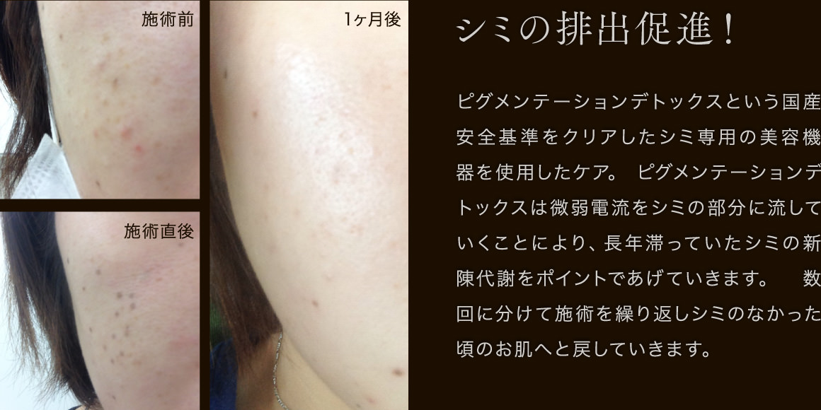 ピグメンテーションデトックスという国産安全基準をクリアしたシミ専用の美容機器を使用したケア。 ピグメンテーションデトックスは微弱電流をシミの部分に流していくことにより、長年滞っていたシミの新陳代謝をポイントであげていきます。 数回に分けて施術を繰り返しシミのなかった頃のお肌へと戻していきます。