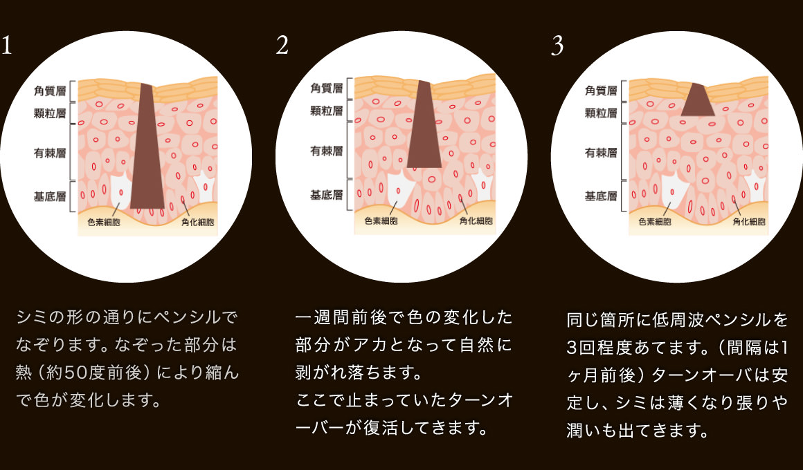 シミの形の通りにペンシルでなぞります。なぞった部分は熱（約50度前後）により縮んで色が変化します。一週間前後で色の変化した部分がアカとなって自然に剥がれ落ちます。ここで止まっていたターンオーバーが復活してきます。同じ箇所に低周波ペンシルを3回程度あてます。（間隔は1ヶ月前後）ターンオーバは安定し、シミは薄くなり張りや潤いも出てきます。