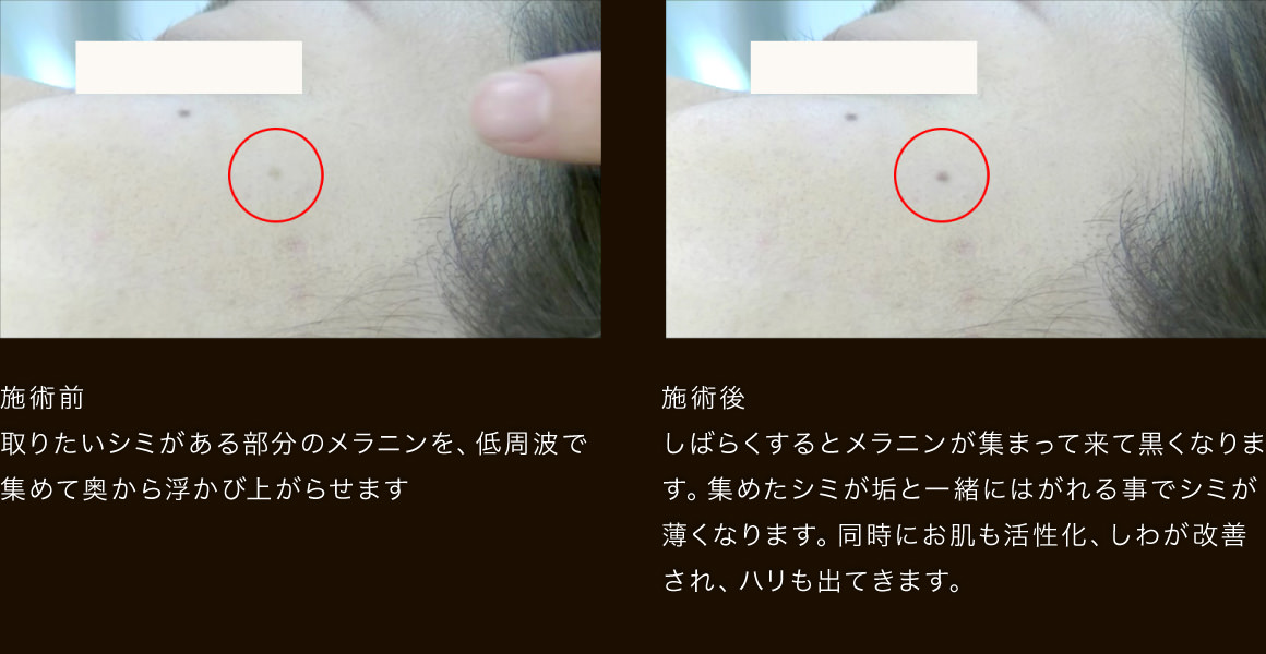 施術前 取りたいシミがある部分のメラニンを、低周波で集めて奥から浮かび上がらせます 施術後 しばらくするとメラニンが集まって来て黒くなります。集めたシミが垢と一緒にはがれる事でシミが薄くなります。同時にお肌も活性化、しわが改善され、ハリも出てきます。